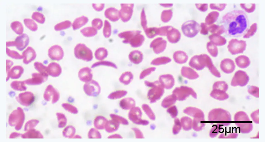 slide:25|type:photo A microscopic blood-smear photograph showing numerous abnormally shaped red blood cells, including crescent-shaped sickle cells, with a 25 μm scale b…